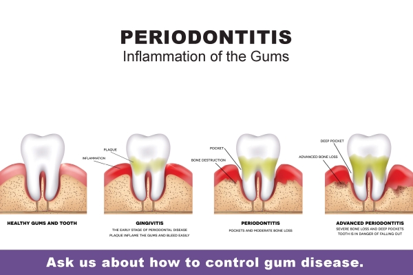 Periodontal Treatment Deep Cleaning Scaling and Root Planing