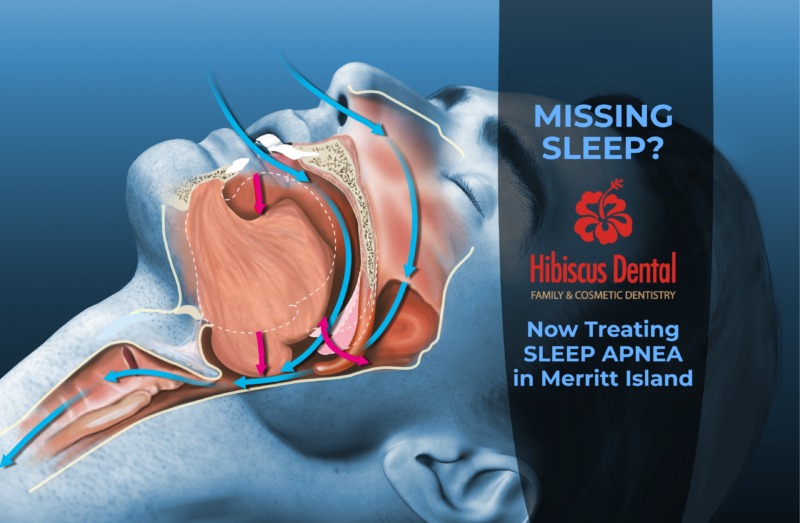 Dental Solutions for Obstructive Sleep Apnea Hibiscus Dental