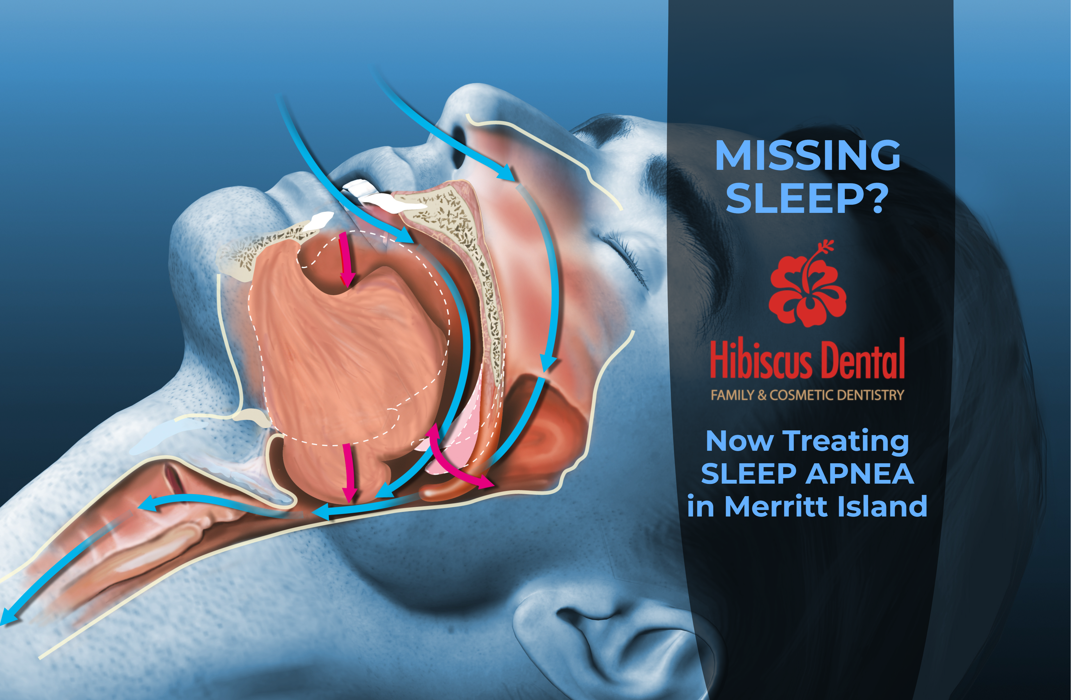 Hibiscus Dentist Sleep Apnea Dental Solution